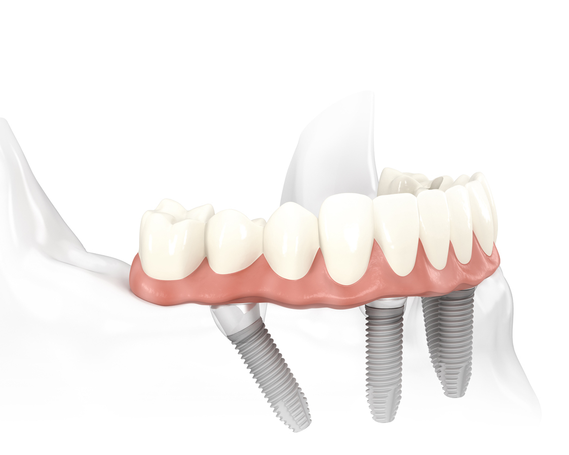 Система all-on-4