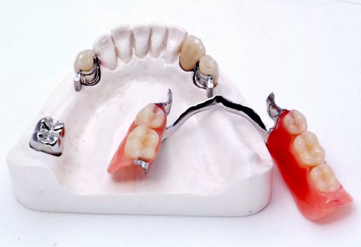 Бюгельный протез