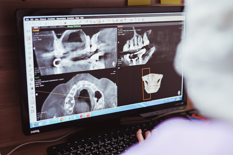 Компьютерная томография