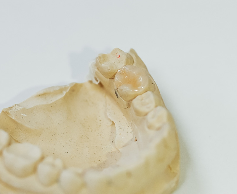 Керамическая коронка e-max