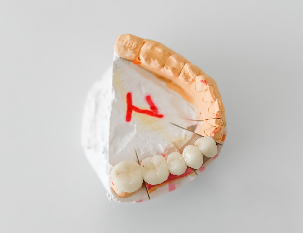 Металлокерамический мост