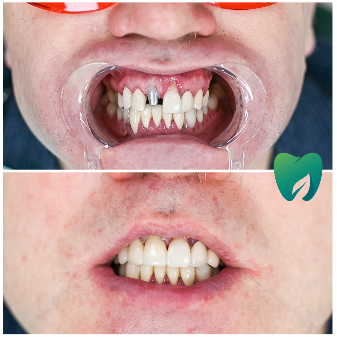 Керамическая коронка