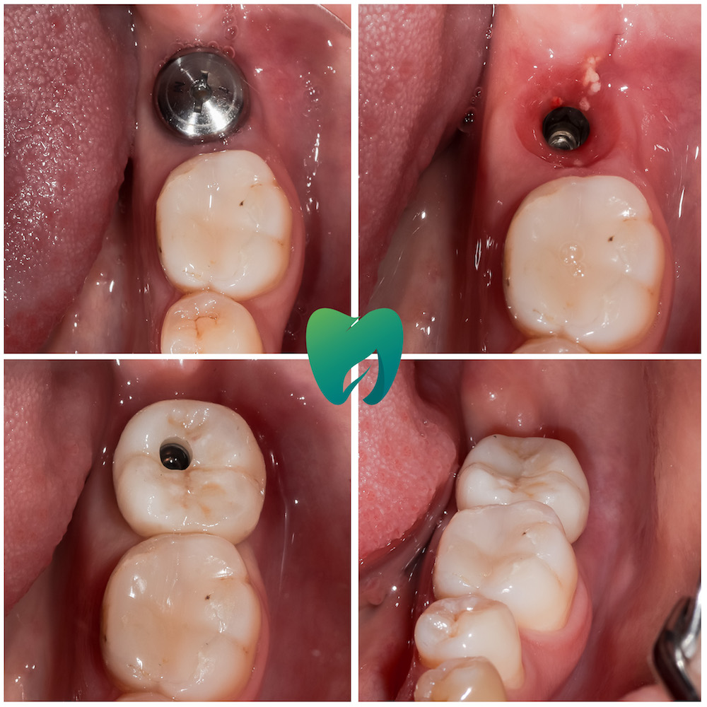 Имплантация зуба