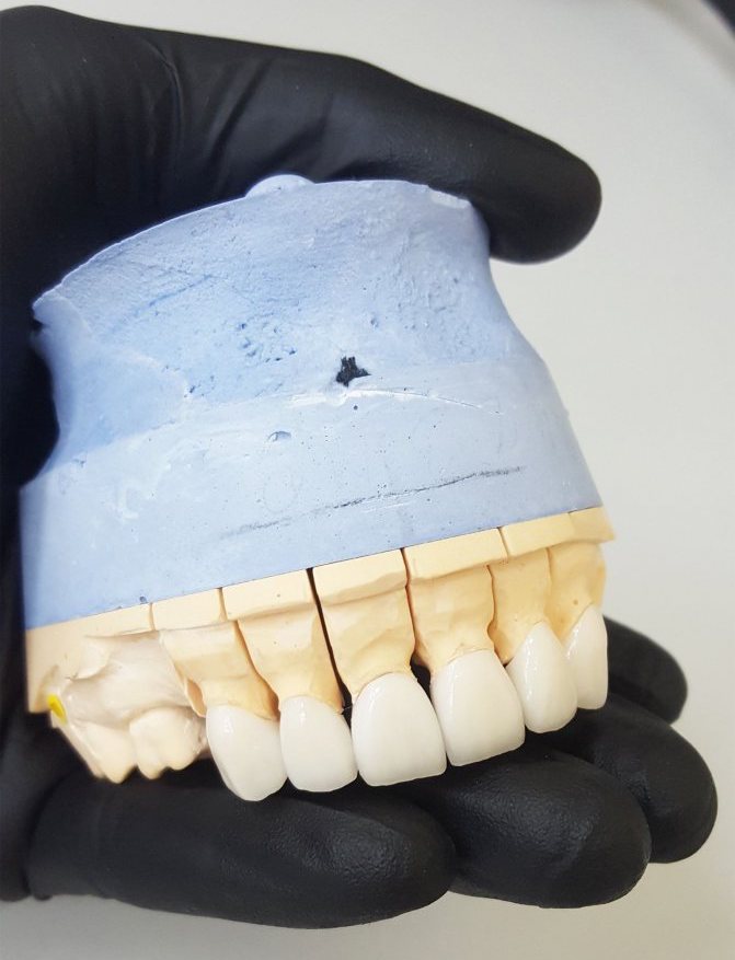 Керамическая коронка