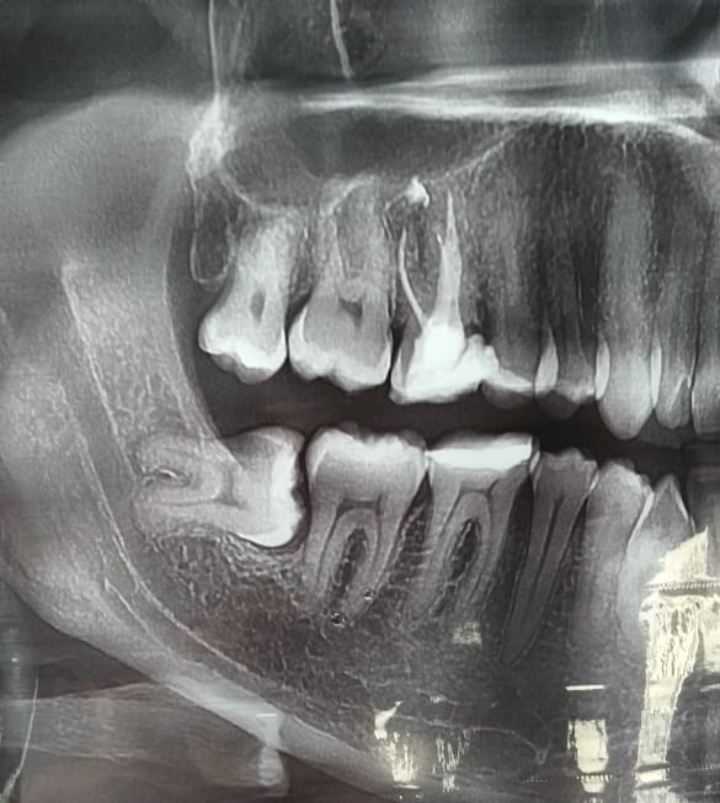 зуб мудрости