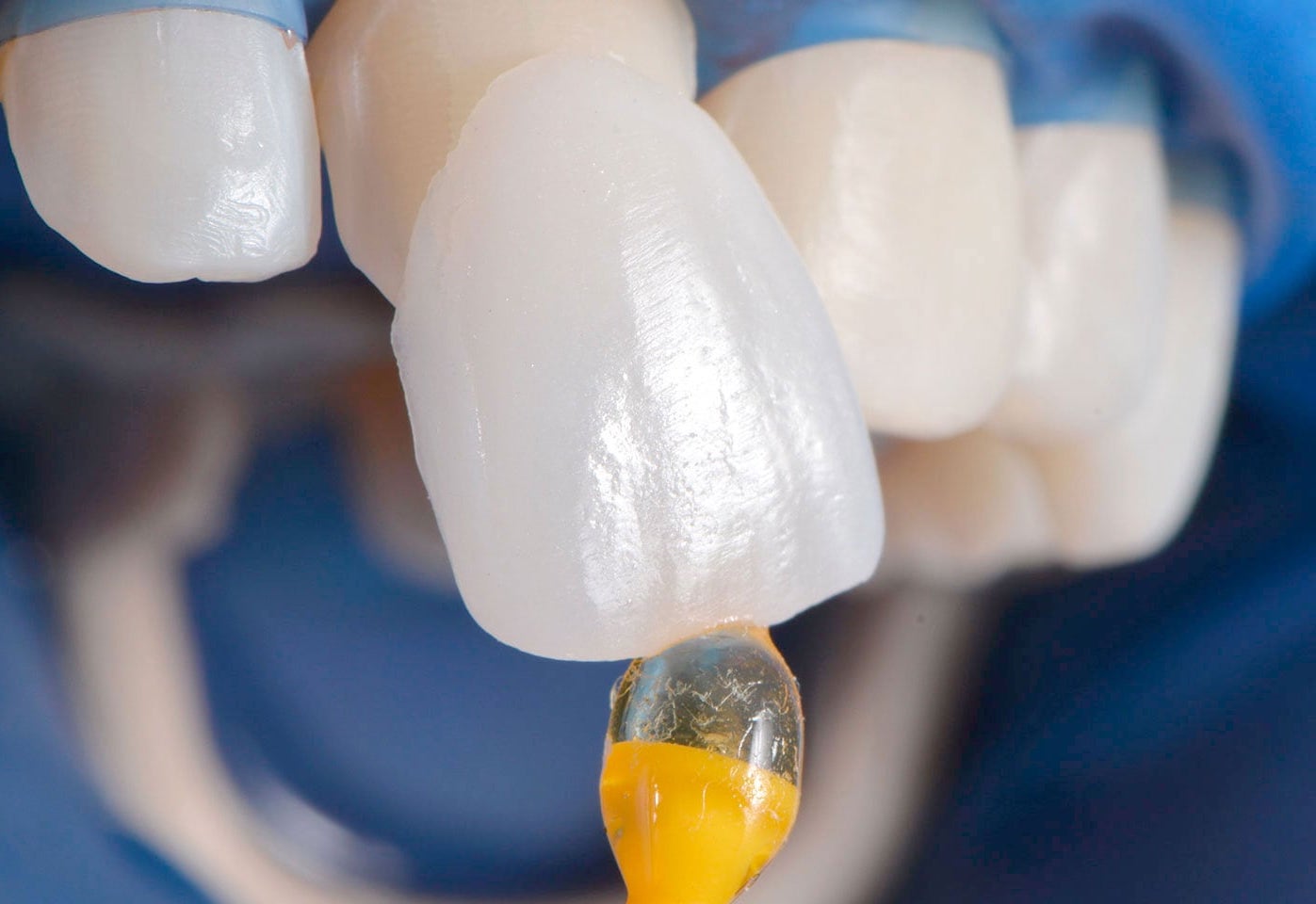 керамический винир красноярск