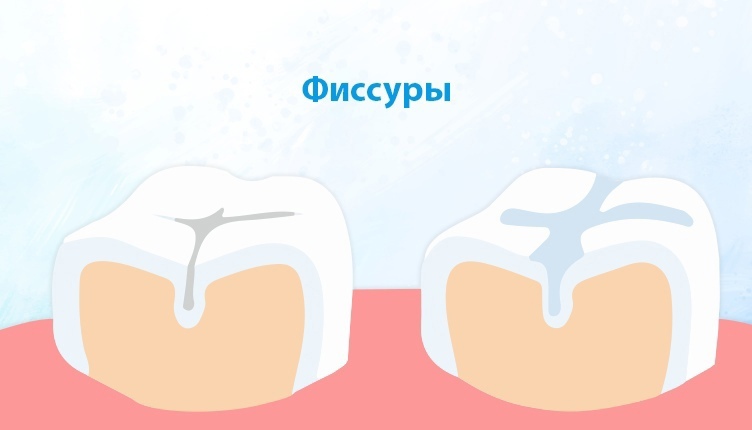 Герметизация фиссур