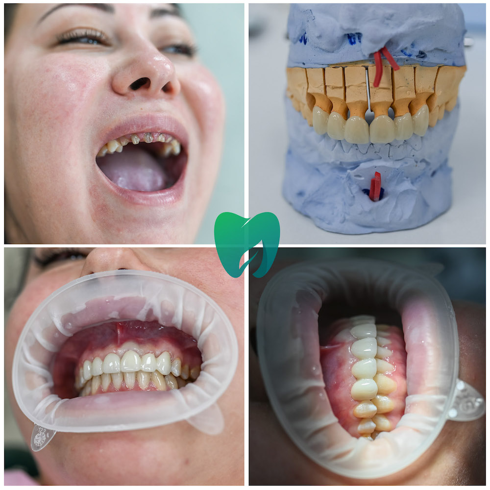 Протезирование передних зубов на диоксиде циркония