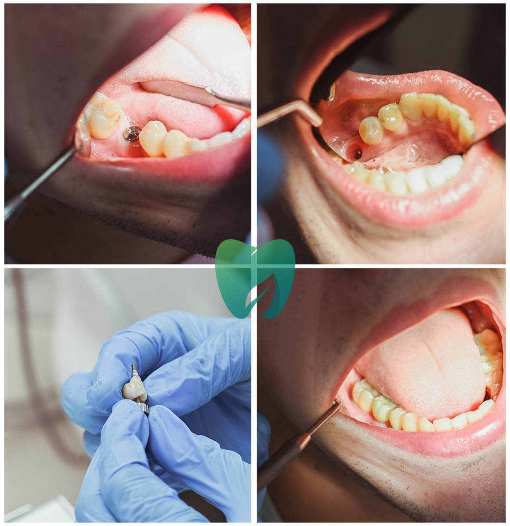 Установленный имплант с коронкой